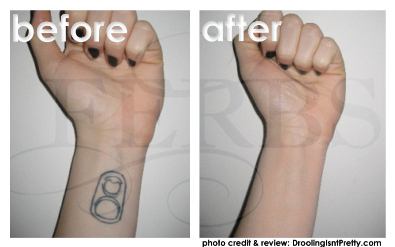 This is one of the oldest methods of tattoo removal and while it might be an